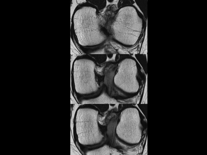 Figure 4 for case anterior cruciate ligament ( RID2781 )
